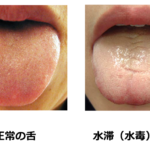 正常な舌と水滞（水毒）の舌の比較写真